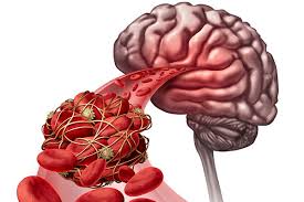 Cerebral venous sinus thrombosis (cvst) is a rare disease capable of leading to severe neurological outcomes, occurs among newborns significantly more frequently than in other age groups. Thrombosis In The Brain Emra