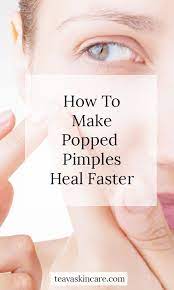 We've got a few simple remedies that will work wonders! How To Make Popped Pimples Heal Faster Teava Skincare Heal Skin Fast Pimples On Face Pimples