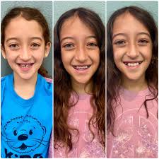 Big day for these siblings!! Kate finished up phase 1 of braces, and Brady  started his braces journey!! 🦷🪥😁#sallapudiorthodontics  #veniceorthodontist #englewoodorthodontist #venicefl #englewoodfl