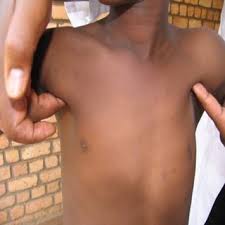 Visit here to view poland syndrome before and after images. Pdf Poland S Syndrome A Case Report