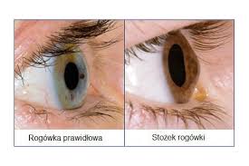 Skóra jest niezwykle cienka (żyły można łatwo zobaczyć przez skórę). Stozek Rogowki Objawy Diagnoza I Leczenie Szkla Com