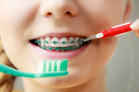 Traditional braces date back to the 18th century by french dentist pierre fauchard as a method of straightening teeth. What Happens If You Have Braces And Don T Brush Your Teeth