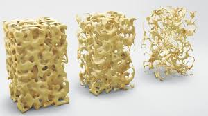 Halk arasında kemik erimesi olarak da bilinen osteoporoz, kemiklerde bulunan mineral yoğunluğunun azalmasına bağlı olarak kemiklerin zayıflaması ve kırılganlaşması olarak tanımlanabilir. Kemik Erimesi Osteoporoz Nedir Kemik Erimesinin Nedenleri Belirtileri Ve Tedavi Yollari Saglik Son Dakika Haberler