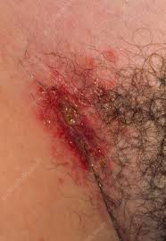 Image result for sore skin in the groin area