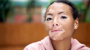 PALLAS LASER ĐÁNH TAN BẠCH BIẾN