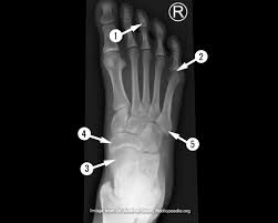 Dense materials, such as bone and metal. Foot Radiograph Anatomy Quiz Radiology Case Radiopaedia Org