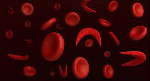 In sickle cell disease, the hemoglobin is abnormal, causing the red blood cells to be rigid and shaped like a c or sickle, the shape from which the disease takes its name. Time Has Finally Come For Sickle Cell Advancements