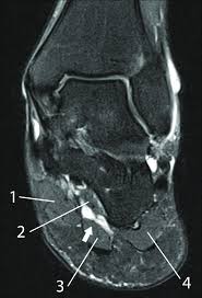 Related posts of foot muscle anatomy mri muscle anatomy trivia. Mri Of The Left Foot In A Normal Patient For Comparison Coronal Download Scientific Diagram