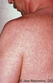 Hives can be different sizes and shapes and appear anywhere on the body in both adults and children. Urticaria American Osteopathic College Of Dermatology Aocd
