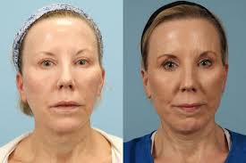 Y Lift Little Rock, AR