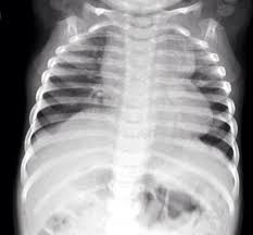 Total anomalous pulmonary venous return (TAPVR) | Radiology Case |  Radiopaedia.org