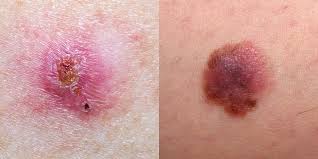 When these cells undergo malignant transformation, merkel cell carcinomas can arise. Skin Cancer Pictures 5 Different Types Of Skin Cancer To Know