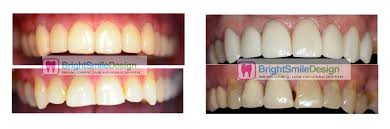 Everyone wants a gorgeous smile. Porcelain Veneers Cosmetic Dentistry Hollywood Smile