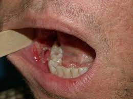 What does it feel like when your the first signs of throat cancer that are common to all three types include a sore throat that does not go early stage cancers of the throat are small, localized, and highly curable when treated with. Throat Cancer Pictures Survival Rate Symptoms Causes Treatment Hubpages