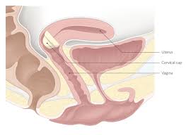 Image result for Cervical Cap