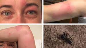 They can bite, he adds. A White Tail Spider Bit Me Seven Times While I Was Asleep