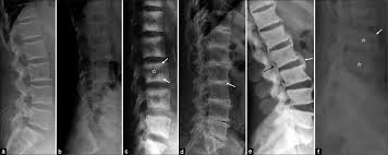 The Forgotten Art Of Plain Radiography In The Evaluation Of Metabolic Bone Disease Indian Journal Of Musculoskeletal Radiology Ijmsr