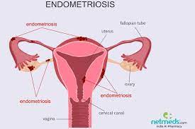 What every woman and her doctor need to know andrew s. Endometriosis Causes Symptoms And Treatment Netmeds
