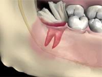 We did not find results for: Wisdom Teeth Removal