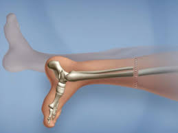 Where are the kidneys located? Surgery For Cancer Replaces Knee With Foot