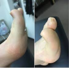 Natural and medication approaches need to be exhausted before reaching for this option. The Banana Hallux When The Big Toe Curls Upward The Gait Guys