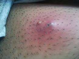 Men are 10 times more likely than women to have fournier's gangrene. Skin And Soft Tissue Infections Amboss