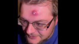 Bbc news provides trusted world and uk news as well as local and regional perspectives. Hot Video Blackheads Removal 2019 By Gaspa Pimple Popper Videos 2019 Pimple Popping Videos