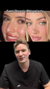 Sami Sheen Nose Before