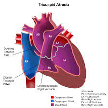Congenital Heart Diseases