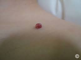 Image result for Pyogenic Granuloma