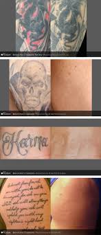Excision can be an ok method for small tattoos, but is somewhat difficult or impossible for larger areas. Tattoo Removal Los Angeles Signature Med Spa By Su Sachar Mdsachar Signature Med Spa