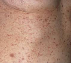 For a cut or scrape, use direct pressure to stop the bleeding. Skin Signs Of Hematologic Disease Fitzpatrick S Color Atlas And Synopsis Of Clinical Dermatology Seventh Edition