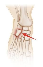 11 Ouch My Foot Ideas Cuboid Syndrome Ouch Sprained Ankle