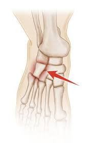 It's also known as cuboid subluxation, which means that one of the bones in a joint is moved but not fully out of place. 11 Ouch My Foot Ideas Cuboid Syndrome Ouch Sprained Ankle