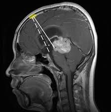 A Recommendable Trajectory For Simultaneous Etv And Biopsy Is Shown As Download Scientific Diagram