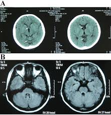 The mri results are actually back within an hour or two, if it is an emergency. Mri Or Ct Scan For Brain Ct Scan Machine