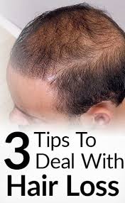 3 Tips To Deal With Hair Loss Hair Loss Men Hair Treatment Thinning Mens Hair Loss Remedies