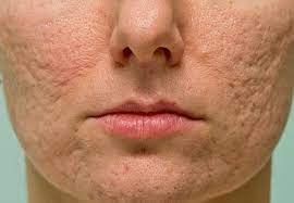 Here's how to get rid of acne scars for good, according to dermatologists. Top 3 Ways To Get Rid Of Acne Scars Health Essentials From Cleveland Clinic