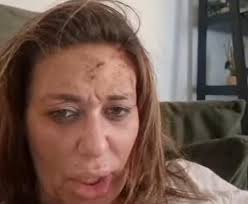 ВОЗНЕМИРУВАЧКА СНИМКА 🟥 Ана Николиќ повторно претепана: „Ве молам јавете  по помош, ми тече крв од сите страни“ (ВИДЕО)