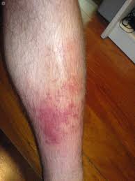 La trombosis venosa superficial es más fácil de detectar. Flebitis Que Es Sintomas Causas Prevencion Y Tratamiento Top Doctors