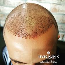 Sacekimi Fuesacekimi Hairtransplant Isvecklinik Sac