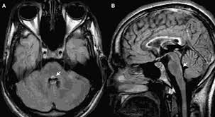 Bom dia amigos, venho aqui pedir ajuda de vcs, há três anos atrás ti.ve uma neurite óptica,e fiz alguns exames de tomografia e ressonância,p ver se. Oftalmoparesia Internuclear Bilateral Secundaria A Esclerose Multipla Relato De Caso Pebmed