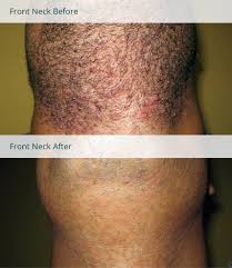 Instead, hair can bend back into skin or grow sideways causing ingrown leg hair. Laser Hair Removal For Folliculitis Milan Laser Hair Removal