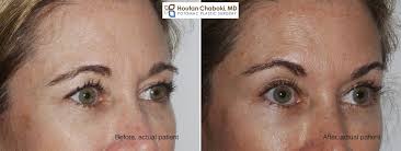 Check spelling or type a new query. Nonsurgical Brow Lift With Botox Or Dysport