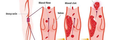 Related online courses on physioplus. What Is Deep Vein Thrombosis Dvt Deep Vein Thrombosis Treatment In India