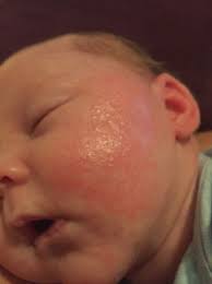 Maybe you would like to learn more about one of these? Help Baby Eczema 5 Week Old Treating Witb Aquaphor Eucerine Amd Steroids Babycenter