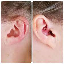 Migraine Piercing 1 Year Results Migraine Piercing Piercing For Migraine Relief Ear Piercing For Migraines