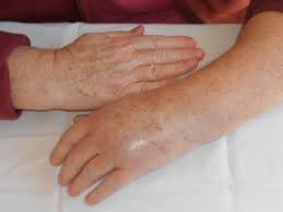 Reducing The Incidence Of Complex Regional Pain Syndrome In Distal Radius Fractures
