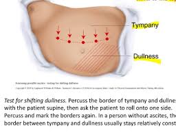 Image result for Shifting Dullness Test