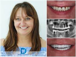 We care for people, not just teeth. our practice was started with the belief that everyone that however, dental implants are not for everyone. Clinical Cases Photos Before And After Dental Work Traveltodentist Chisinau Moldova